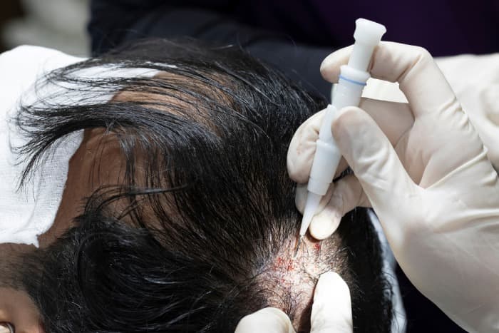 Affordable Hair Transplant Istanbul Services by Sapphire Hair Clinic