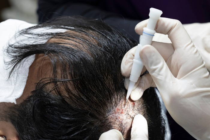 Affordable Hair Transplant Istanbul Services by Sapphire Hair Clinic